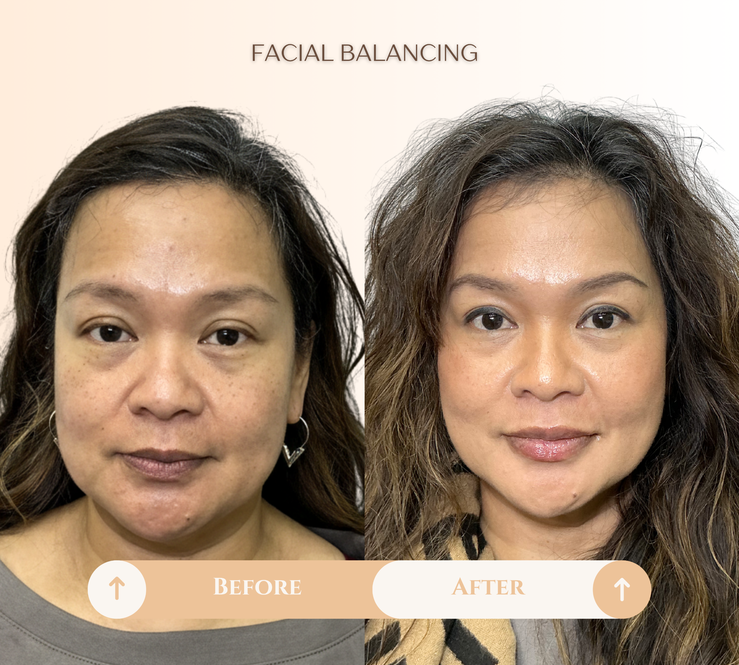 Facial balancing before and after result