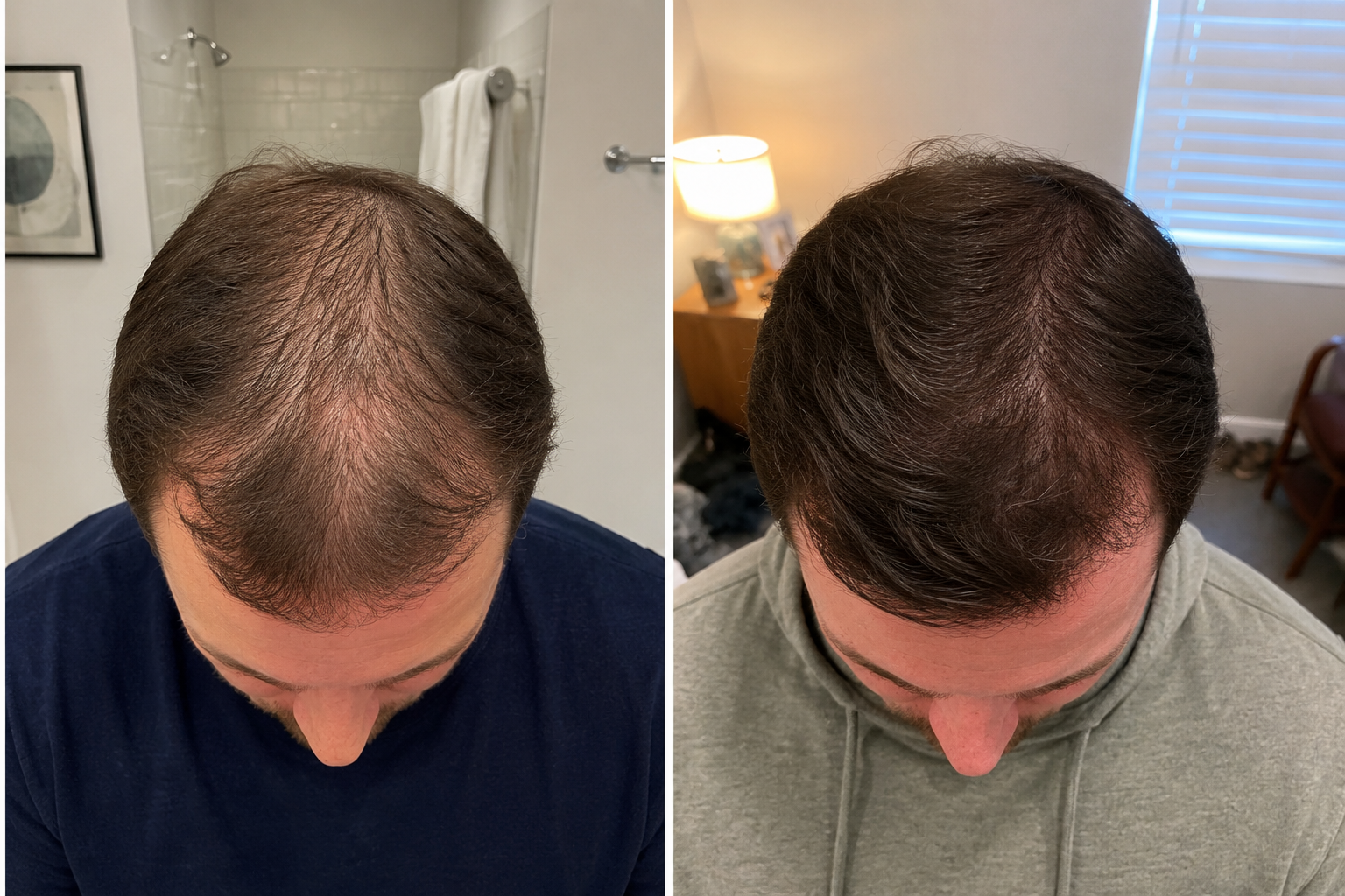 Male hair density before and after comparison
